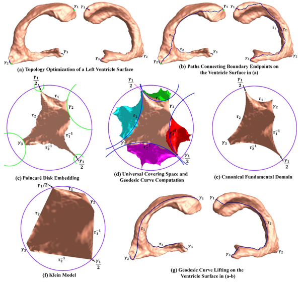 Image of Ventricular shape and relative position abnormalities in preterm neonates