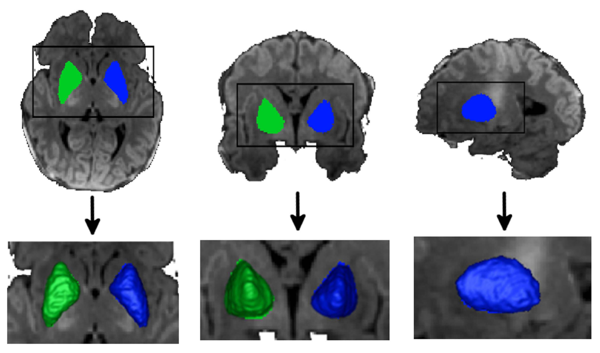 Image 2 of A Multivariate Surface-Based Analysis of the Putamen in Premature Newborns: Regional Differences within the Ventral Striatum
