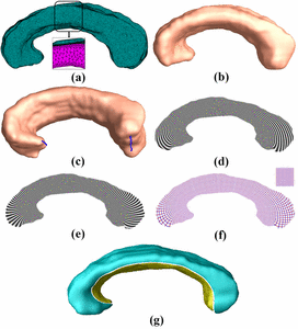 Image of Impact of Early and Late Visual Deprivation on the Structure of the Corpus Callosum: A Study Combining Thickness Profile with Surface Tensor-based Morphometry