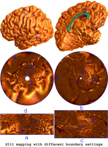 Image of Applying Tensor-based Morphometry to Parametric Surfaces can Improve MRI-based Disease Diagnosis
