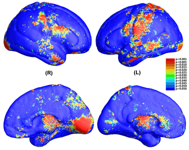 Image of Applying Tensor-based Morphometry to Parametric Surfaces can Improve MRI-based Disease Diagnosis
