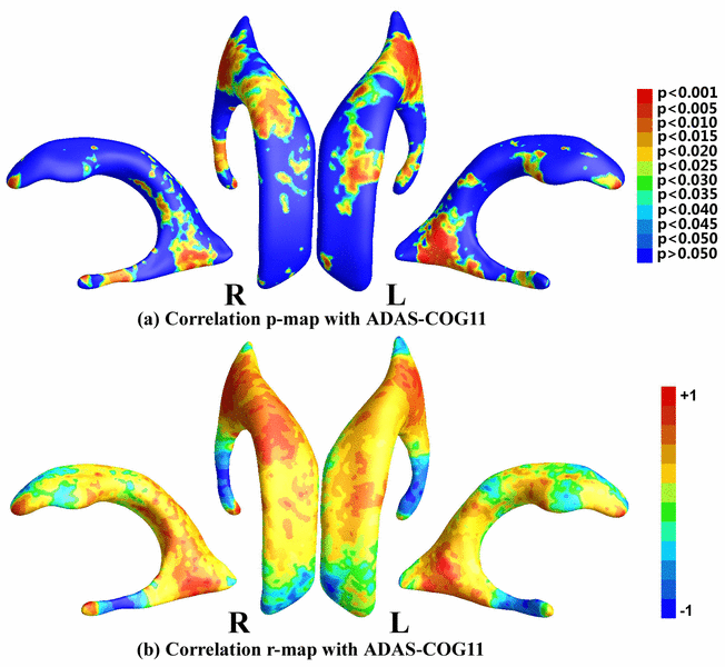 Image of Studying Ventricular Abnormalities in Mild Cognitive Impairment with Hyperbolic Ricci Flow and Tensor-based Morphometry