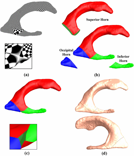Image of Studying Ventricular Abnormalities in Mild Cognitive Impairment with Hyperbolic Ricci Flow and Tensor-based Morphometry